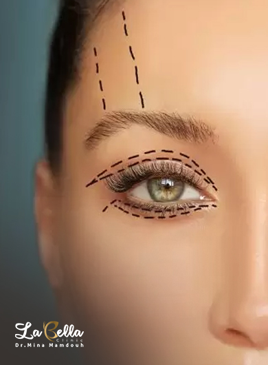 تجميل الجفون