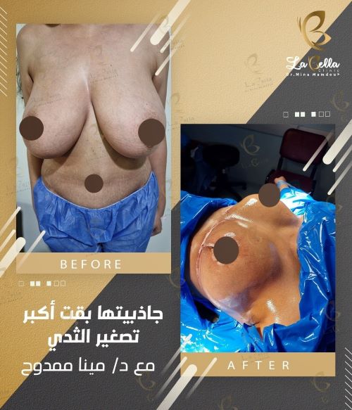 جاذبيتها بقت أكبر تصغير الثدي
