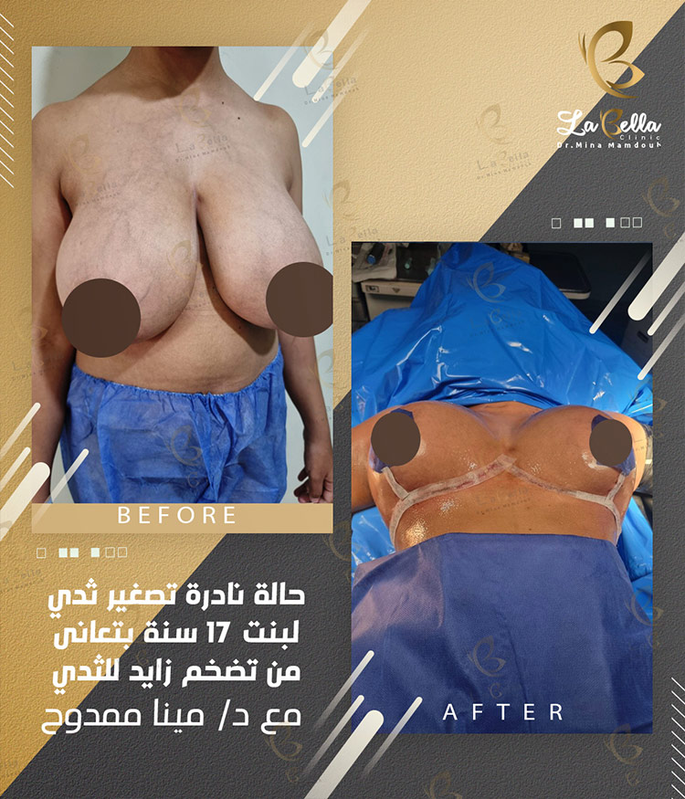 تصغير الثدي